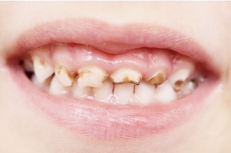 Antibiótico estraga os dentes ?